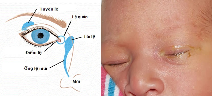 PHẢI LÀM GÌ KHI MẮT BÉ BỊ ĐỔ GHÈN?