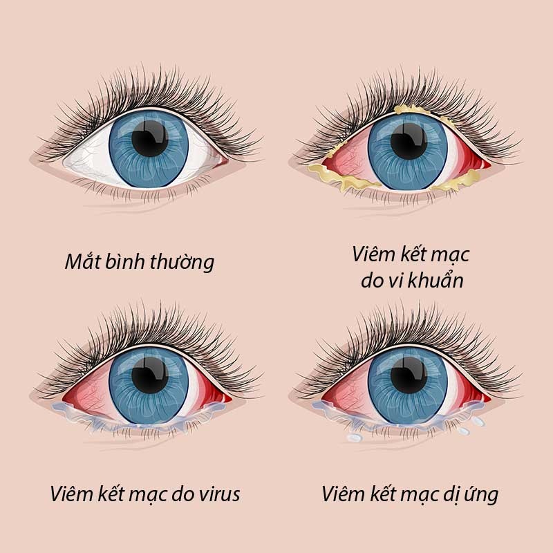 PHẢI LÀM GÌ KHI MẮT BÉ BỊ ĐỔ GHÈN?