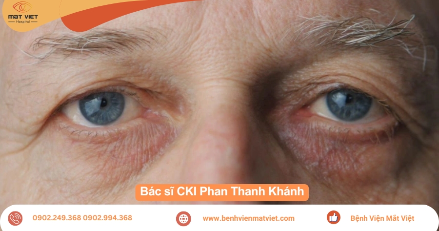 Câu 2: Tại sao bệnh đục thuỷ tinh thể lại làm dẫn đến mù vĩnh viễn nếu không điều trị kịp thời? Và làm thế nào để phát hiện bệnh ở giai đoạn sớm nhất để tránh nguy cơ mù lòa ?