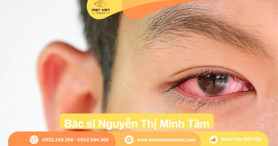 Viêm kết mạc (đau mắt đỏ)