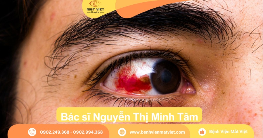 Xuất huyết dưới kết mạc